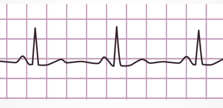 EKG Sample